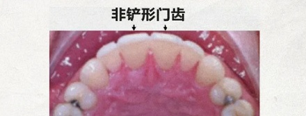 为什么全世界只有中国人的门牙像个小铲子?