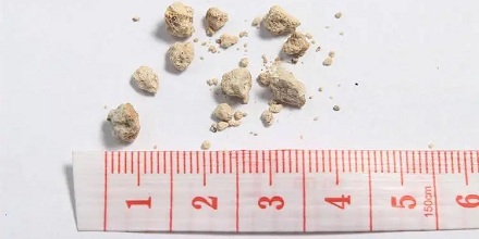 治疗「肾结石膀胱结石」小偏方一副!