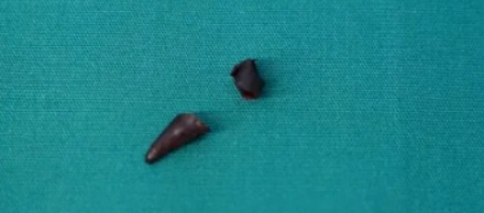 为什么肺里的辣椒尖特别容易被误诊成肿瘤？