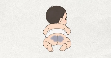 为什么大多数亚洲婴儿出生时，屁股上会有一大片青色斑块？