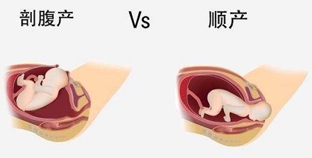剖腹产和顺产哪个比较好?