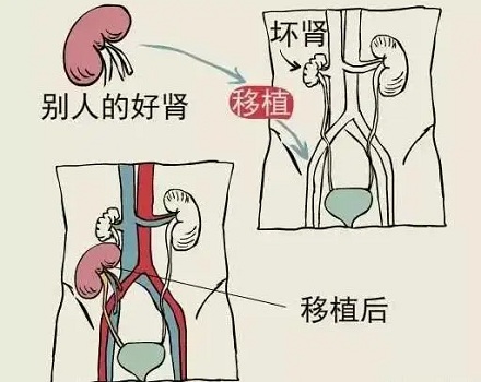你了解肾脏移植手术吗?