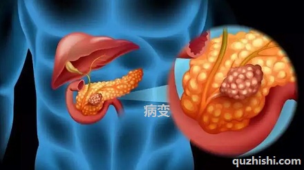 哪些人群最宜罹患「胰腺癌」?